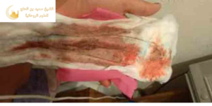 جلب الزوج العنيد بدم الحيض